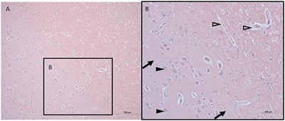 Brain Histology and Immunohistochemistry After Resuscitation From Hemorrhagic Shock in Swine With Pre-Existing Atherosclerosis and Sodium Thiosulfate (Na2S2O3) Treatment